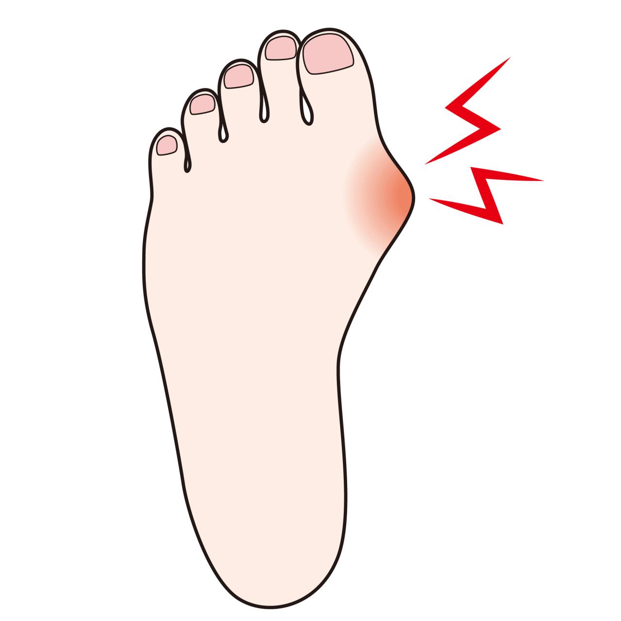 【外反母趾】痛みが消えるのは悪化のサイン!? 放置すると激痛を引き起こす【強剛母趾】も要チェック（画像4）