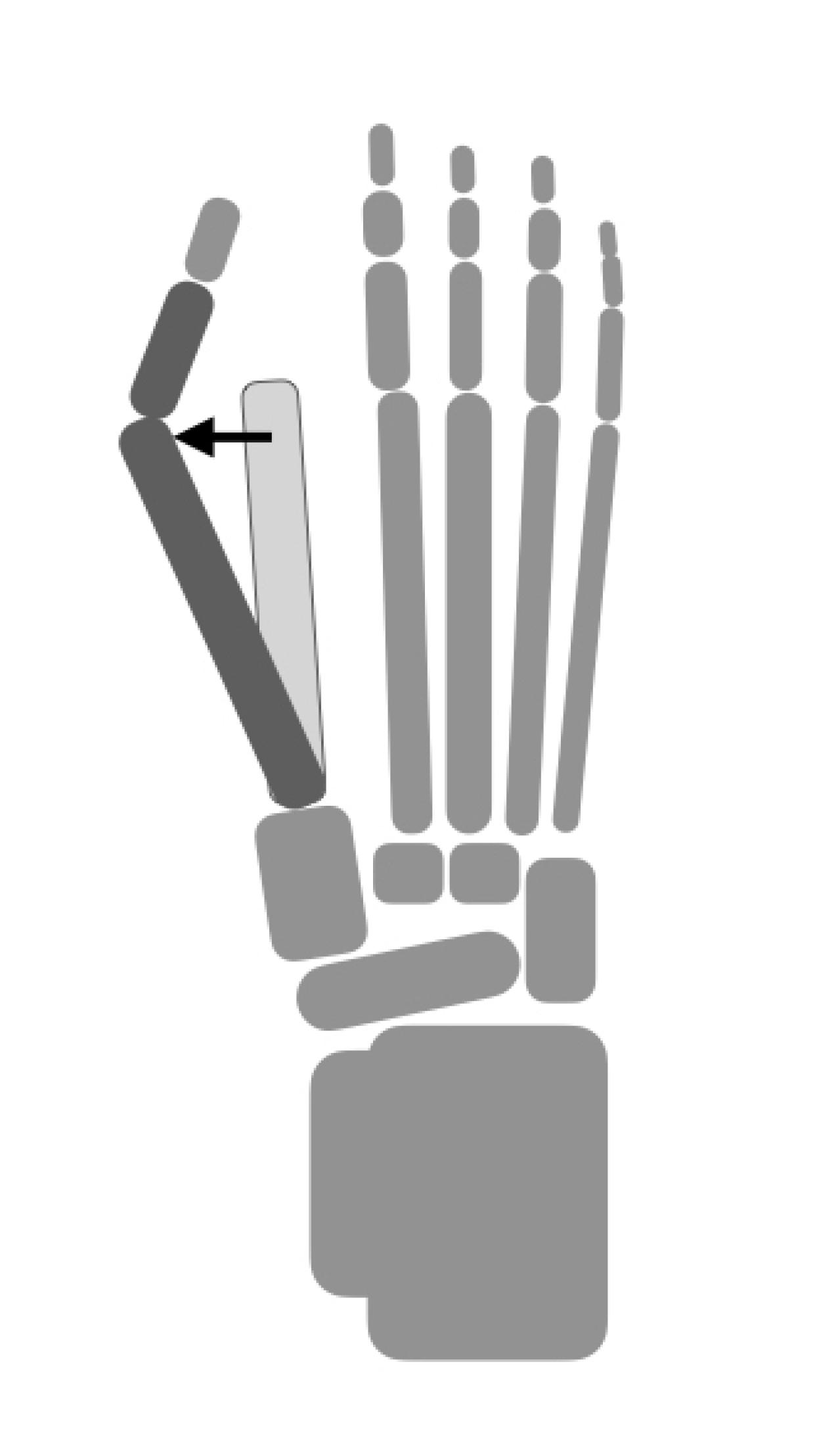 【外反母趾】痛みが消えるのは悪化のサイン!? 放置すると激痛を引き起こす【強剛母趾】も要チェック（画像5）