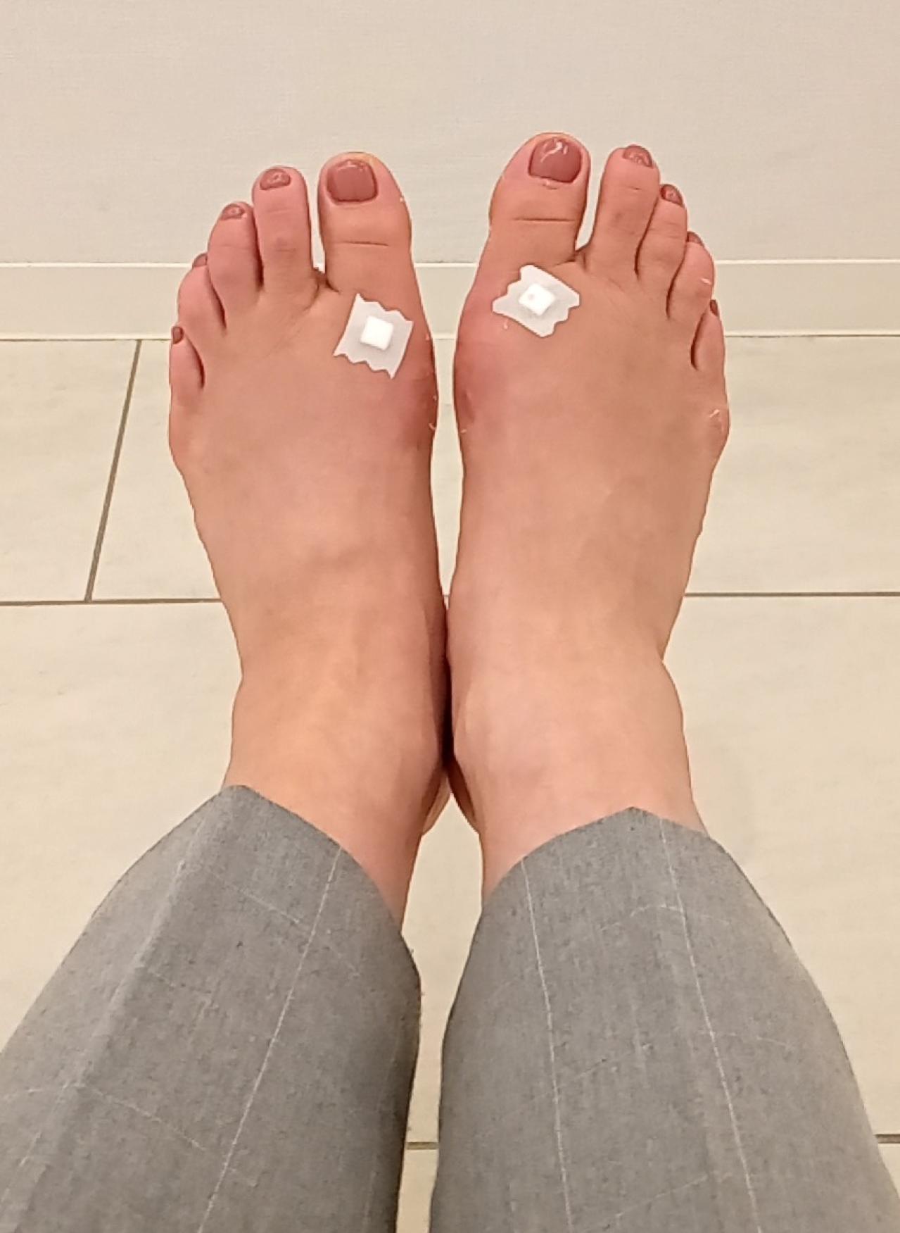 【外反母趾】痛みが消えるのは悪化のサイン!? 放置すると激痛を引き起こす【強剛母趾】も要チェック（画像7）