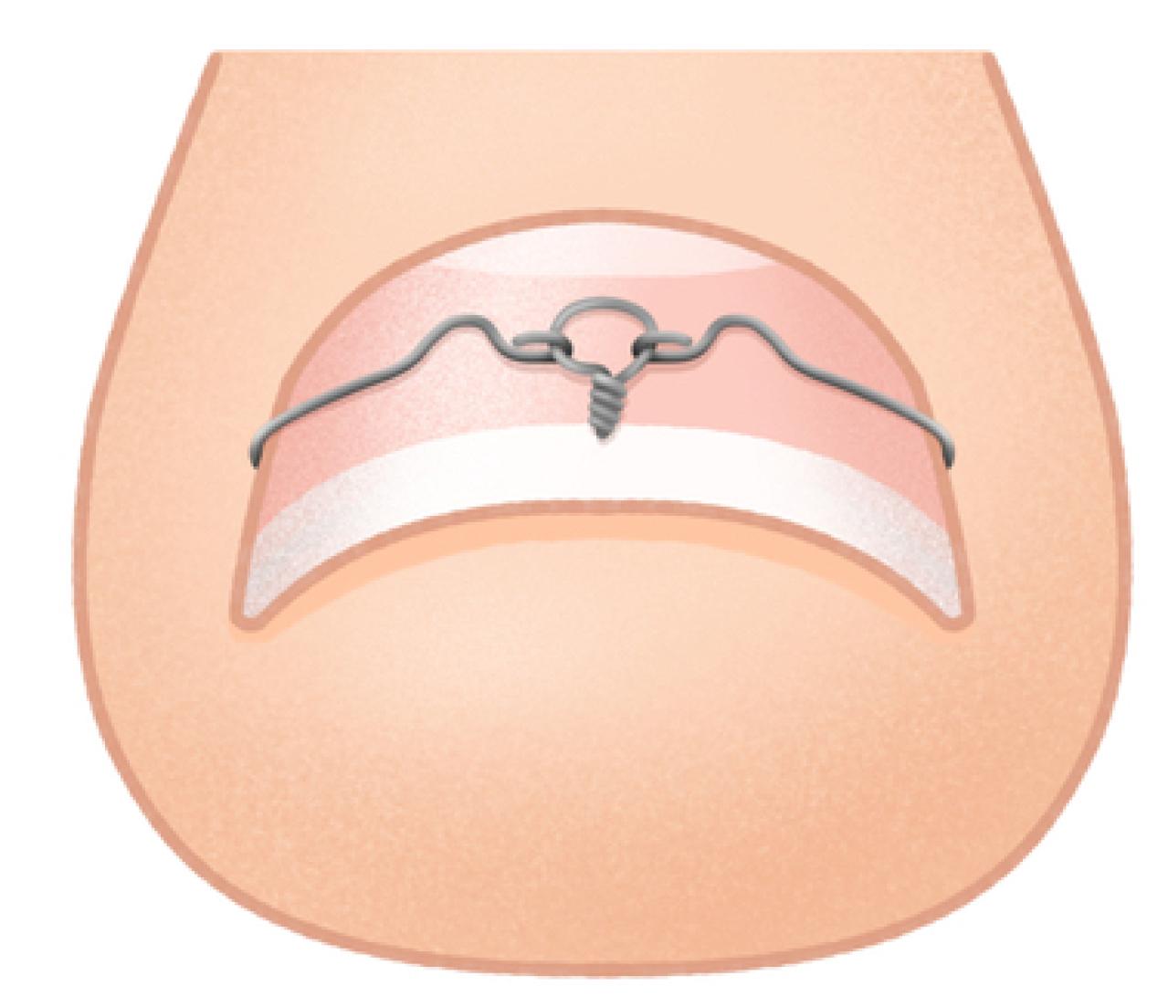 【巻き爪】の原因は実は爪じゃなかった…！ヒールのある靴をよく履く人が注意すべきことも（画像7）