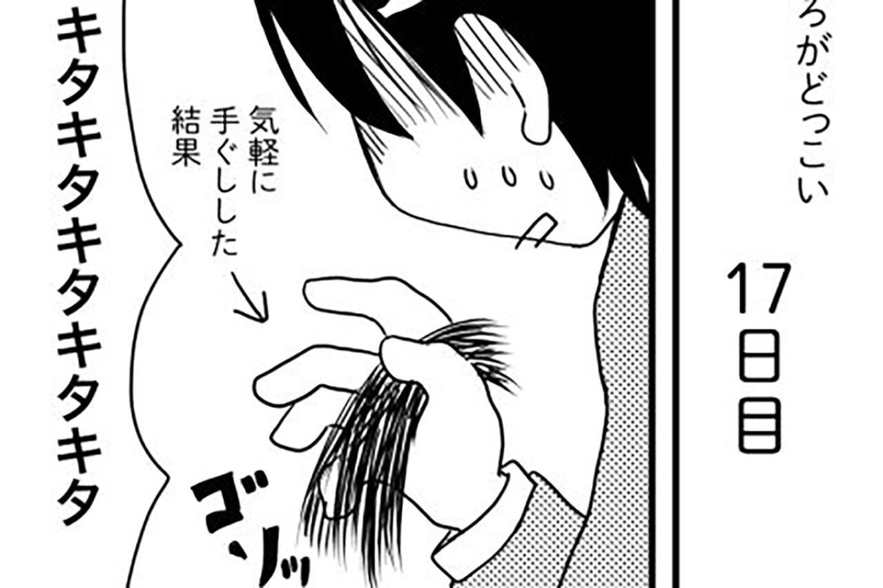 抗がん剤の副作用による脱毛…髪の毛の抜け方は？【乳癌日記 #16】