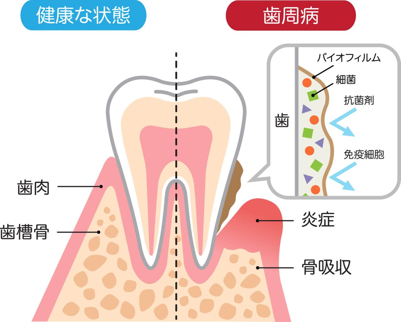 「60代以上は放置すると危険！」糖尿病や認知症にもなりうる【歯周病菌】今すぐできる予防法は？（画像3）