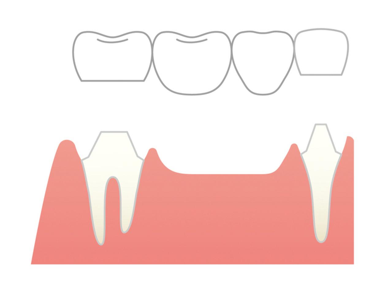 【50代からの歯のお手入れ】歯を失ったら…？医師が解説する「インプラントOKな場合とNGな場合」（画像4）