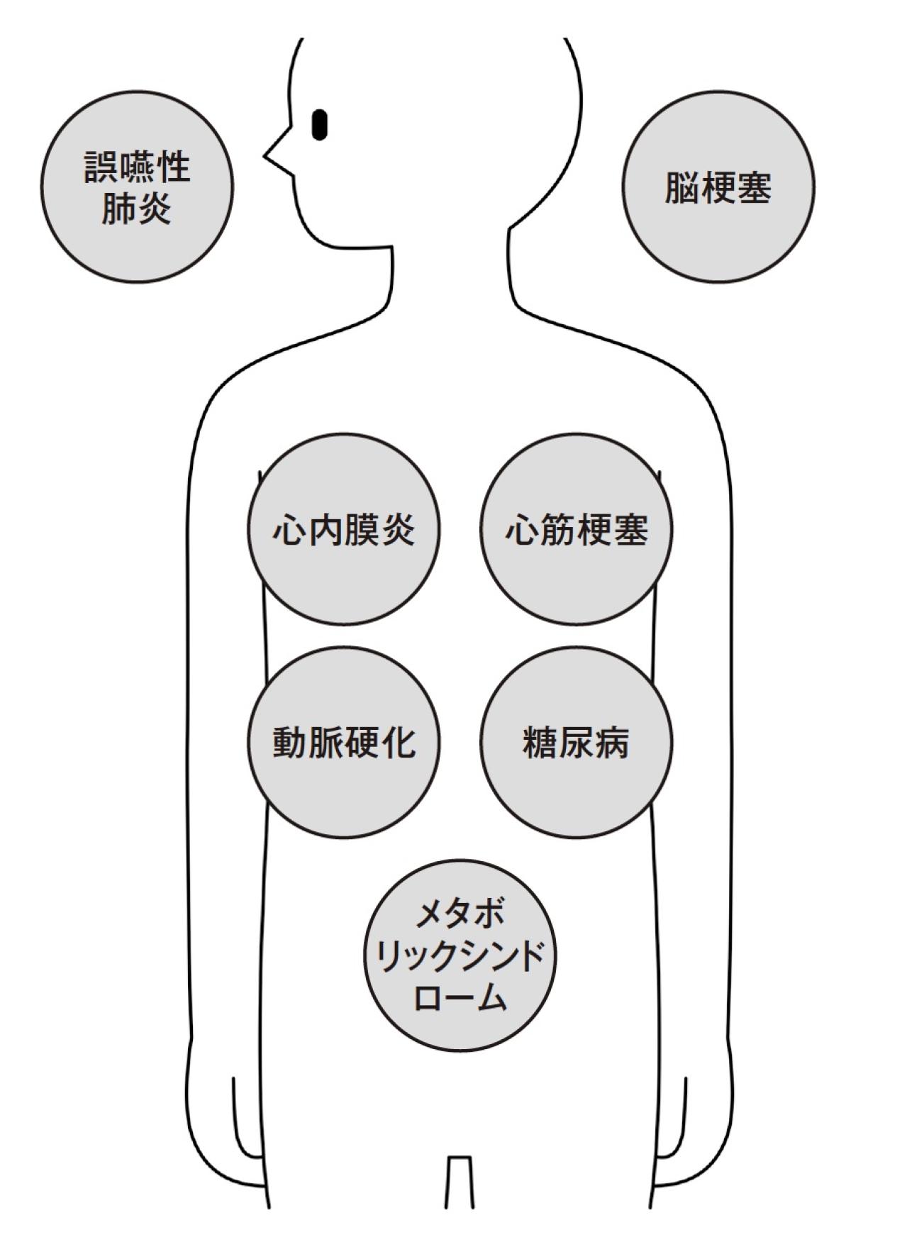 「60代以上は放置すると危険！」糖尿病や認知症にもなりうる【歯周病菌】今すぐできる予防法は？（画像4）