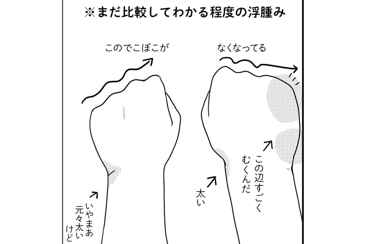 リンパ浮腫を発症。むくみをとるのに必要なのは…？【乳癌日記 #51】