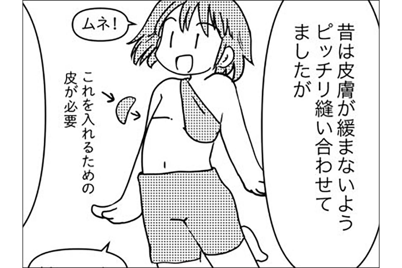 胸の全摘手術・今昔。今と昔で変わったことは？【乳癌日記 #54】