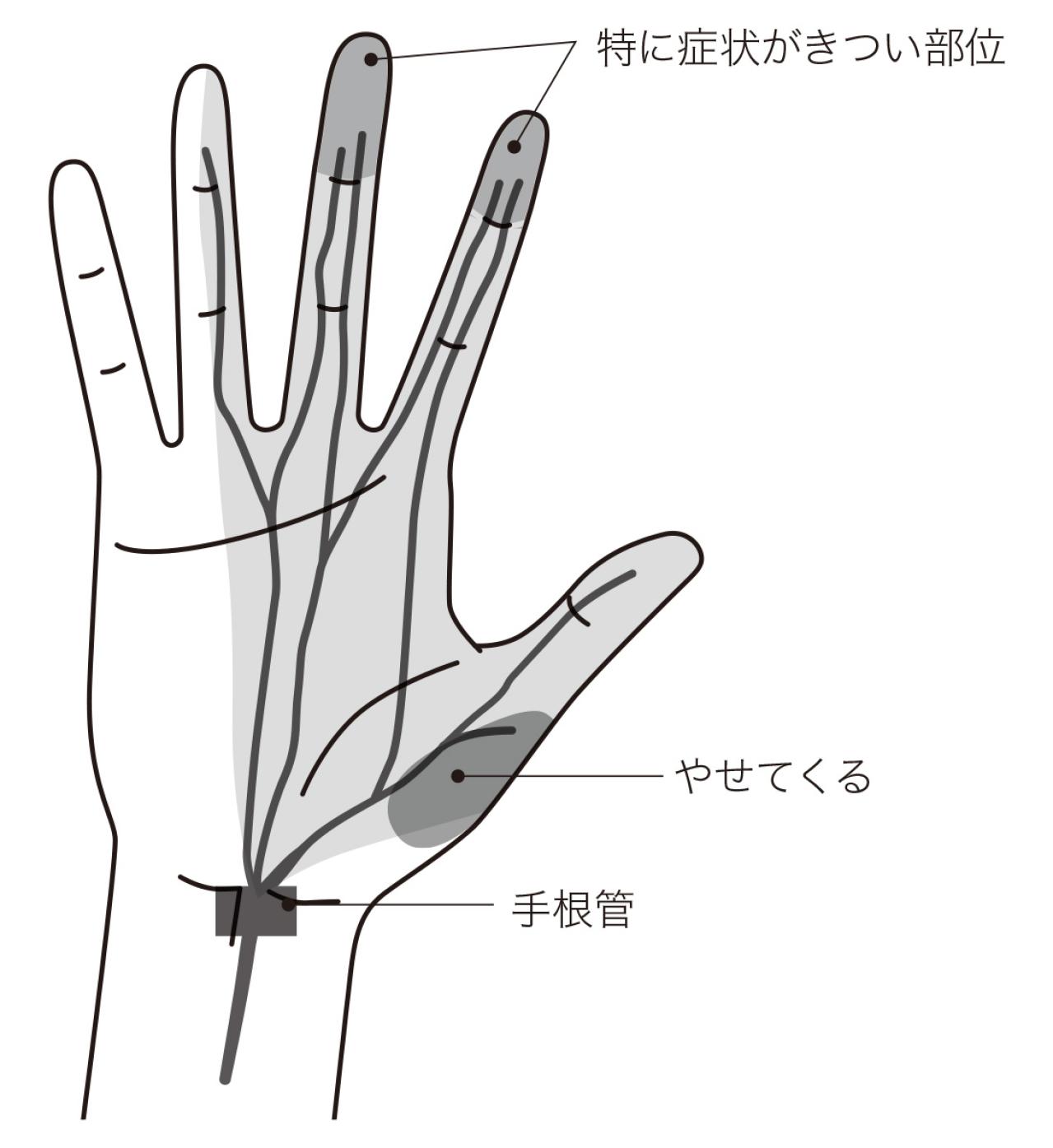 指先の細かい作業ができない！「手根管症候群」とは？症状と簡単セルフケア【医師が解説】（画像2）