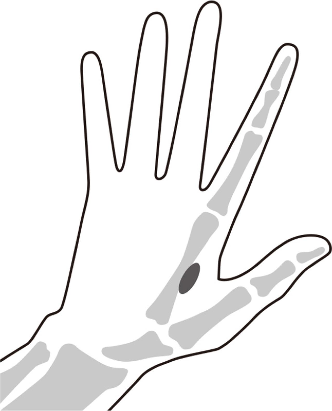 中高年女性の「指に力が入らない」「ふたが開けられない」へバーデン結節にも！【10秒神経マッサージ】とは？（画像4）