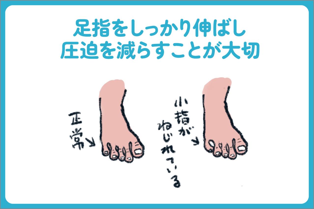 小指の爪が小さい人は要注意？夏前に始めたい巻き爪・足トラブル対策【足連載／第９歩】（画像5）