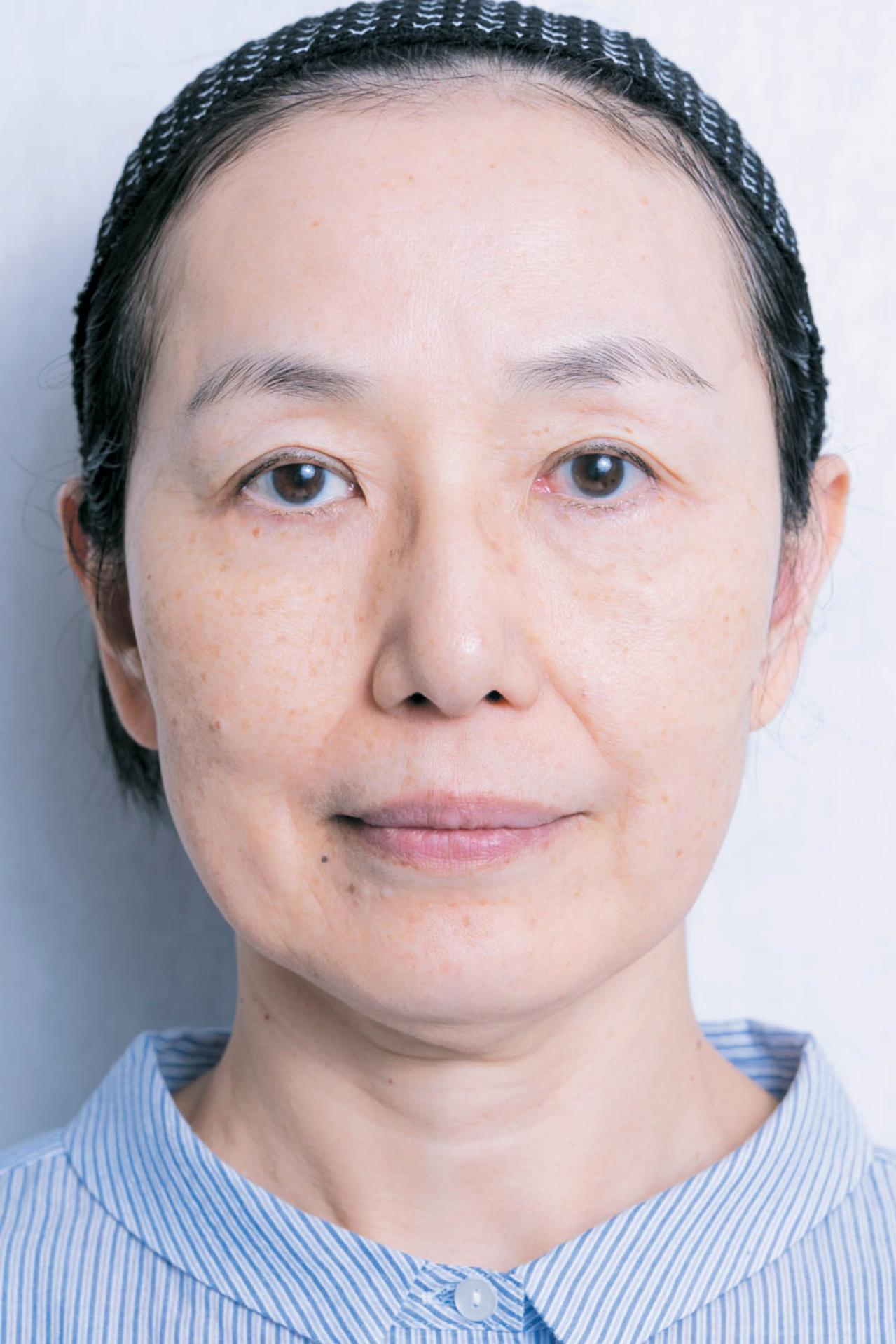 56歳読者モデルが体験！シミ・くすみに効く光治療（IPL）当日の流れと痛み、2日目の変化まで（画像3）