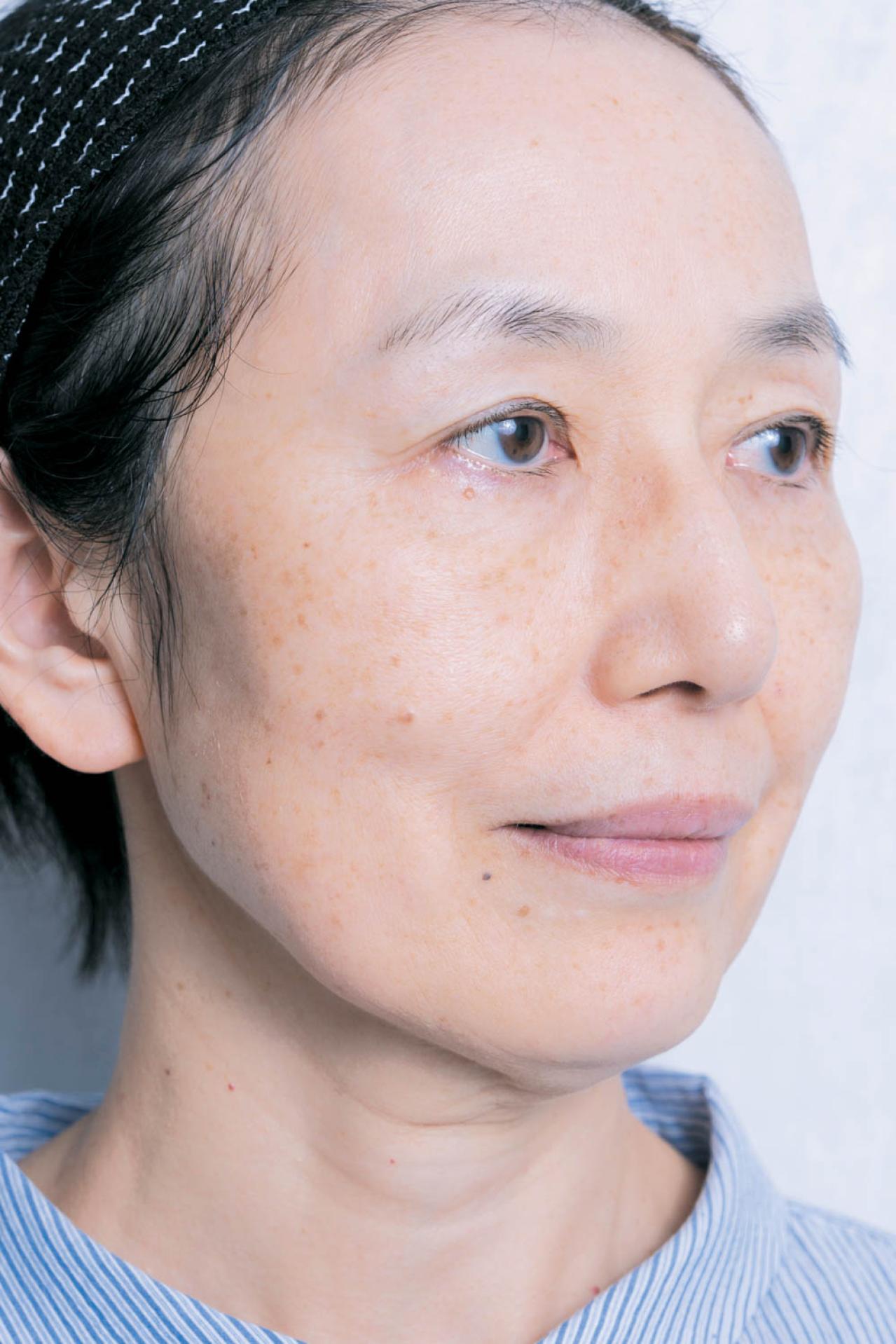 56歳読者モデルが体験！シミ・くすみに効く光治療（IPL）当日の流れと痛み、2日目の変化まで（画像2）