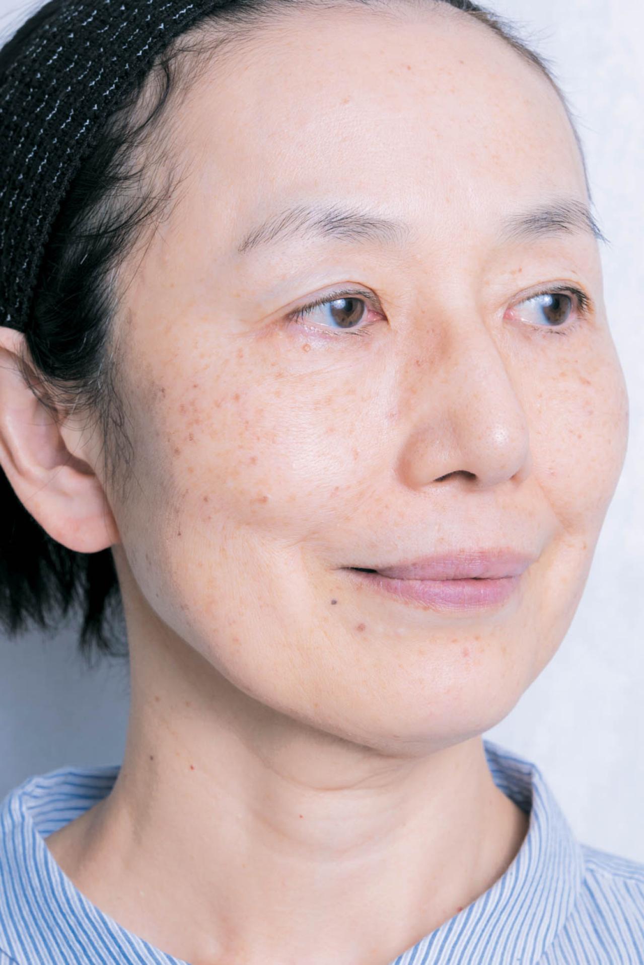 56歳読者モデルが体験！シミ・くすみに効く光治療（IPL）当日の流れと痛み、2日目の変化まで（画像12）