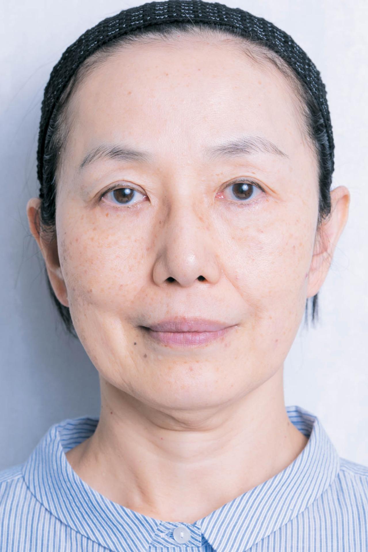 56歳読者モデルが体験！シミ・くすみに効く光治療（IPL）当日の流れと痛み、2日目の変化まで（画像13）