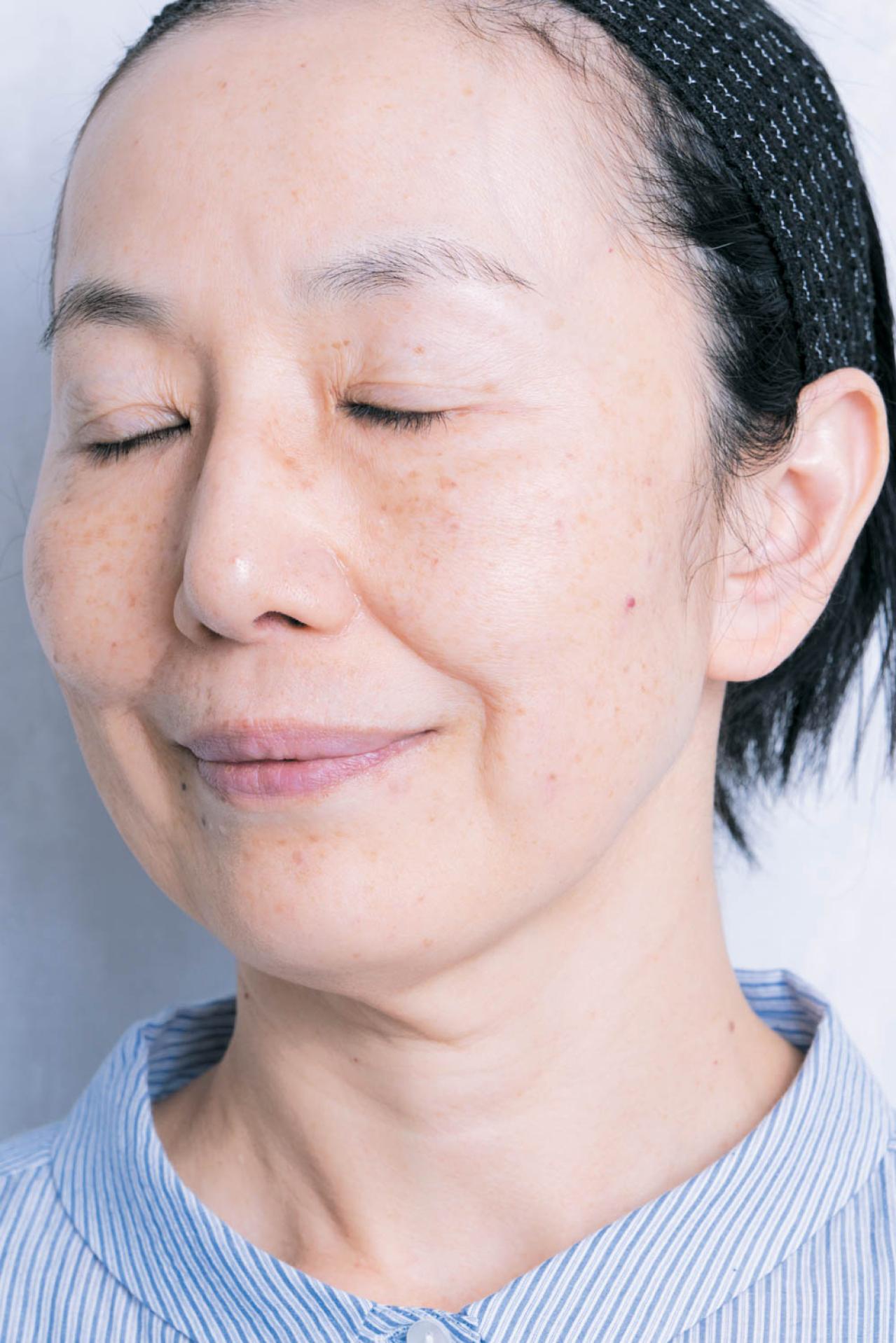 56歳読者モデルが体験！シミ・くすみに効く光治療（IPL）当日の流れと痛み、2日目の変化まで（画像14）