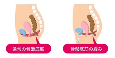 【頻尿・尿漏れ】になりやすい3つのタイプとは？ それぞれの改善法も公開！（サムネイル画像3）