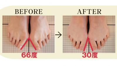 「妻のO脚を治したい！」理学療法士が開発した【5本指ソックス】その実力を編集部がレポート！（サムネイル画像5）