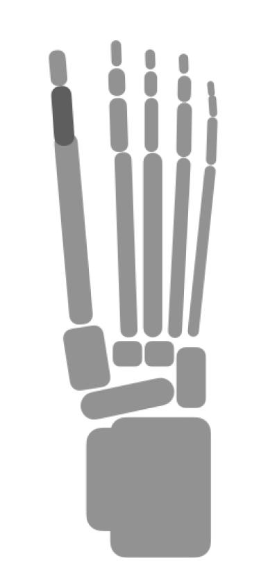 【外反母趾】痛みが消えるのは悪化のサイン!? 放置すると激痛を引き起こす【強剛母趾】も要チェック（サムネイル画像8）