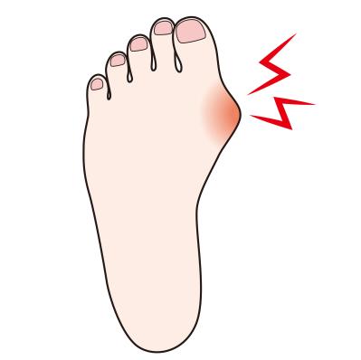 【外反母趾】痛みが消えるのは悪化のサイン!? 放置すると激痛を引き起こす【強剛母趾】も要チェック（サムネイル画像4）