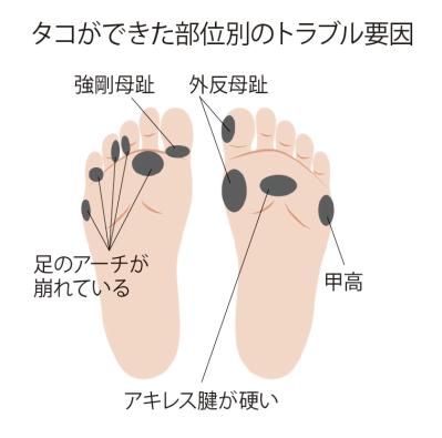 【タコ・ウオノメ】軽く考えちゃダメ！ 「皮膚が硬くなっただけ」ではない足のトラブルとは？（サムネイル画像4）