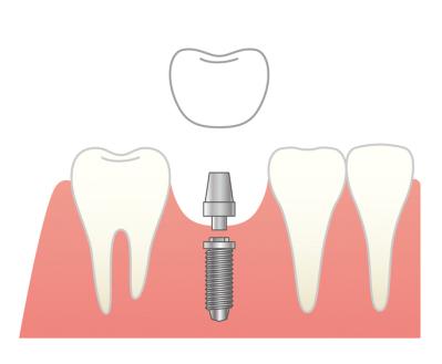 【50代からの歯のお手入れ】歯を失ったら…？医師が解説する「インプラントOKな場合とNGな場合」（サムネイル画像3）