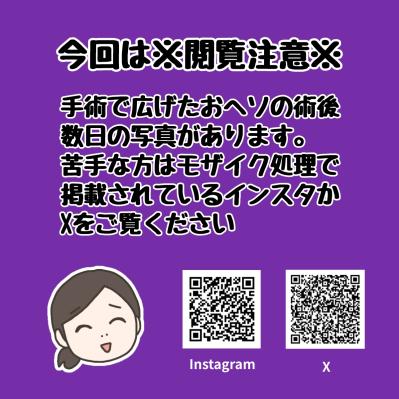 【最終回】子宮全摘手術から1年半…悩みに悩んで全摘した感想は？【実録！40代婦人科トラブル＃51】（サムネイル画像2）