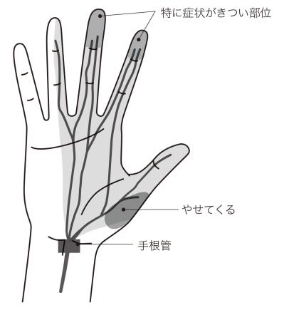 指先の細かい作業ができない！「手根管症候群」とは？症状と簡単セルフケア【医師が解説】（サムネイル画像2）