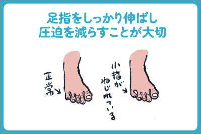 小指の爪が小さい人は要注意？夏前に始めたい巻き爪・足トラブル対策【足連載／第９歩】（サムネイル画像5）