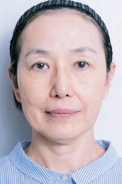 56歳読者モデルが体験！シミ・くすみに効く光治療（IPL）当日の流れと痛み、2日目の変化まで（サムネイル画像3）